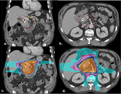 Relationship of dose to vascular target volumes and local failure in pancreatic cancer patients undergoing neoadjuvant chemoradiation